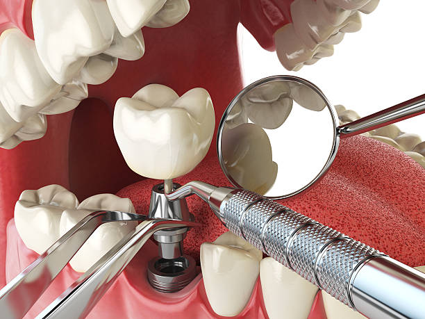 Best Emergency Wisdom Teeth Removal in Lompoc, CA